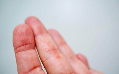 Effective Wart Removal Near Me: Top Treatment Options